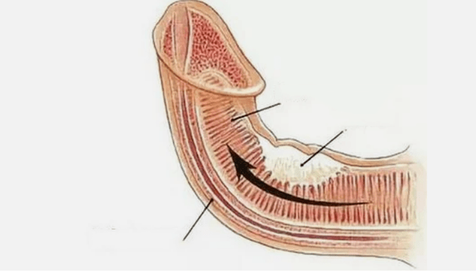 Venous irteera ezabatzea